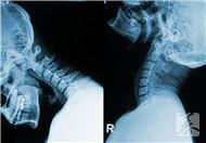 頸椎腰椎病的防治與調理方法有哪些？能好嗎？